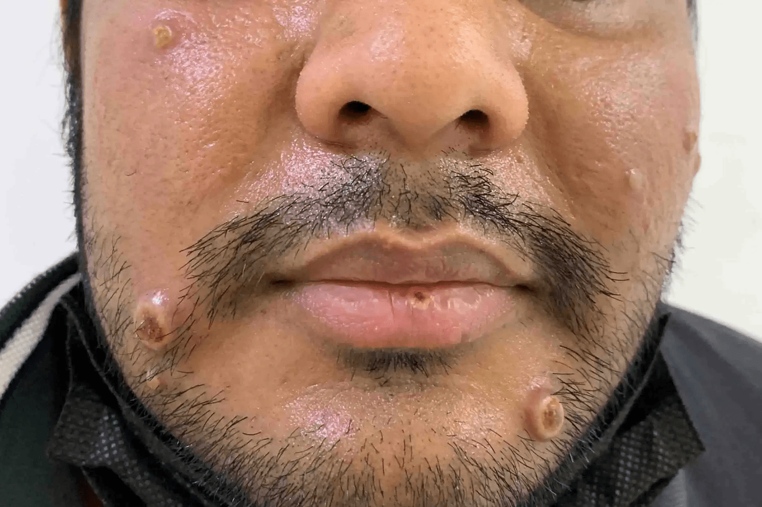 monkeypox 0001 copy.width 1534