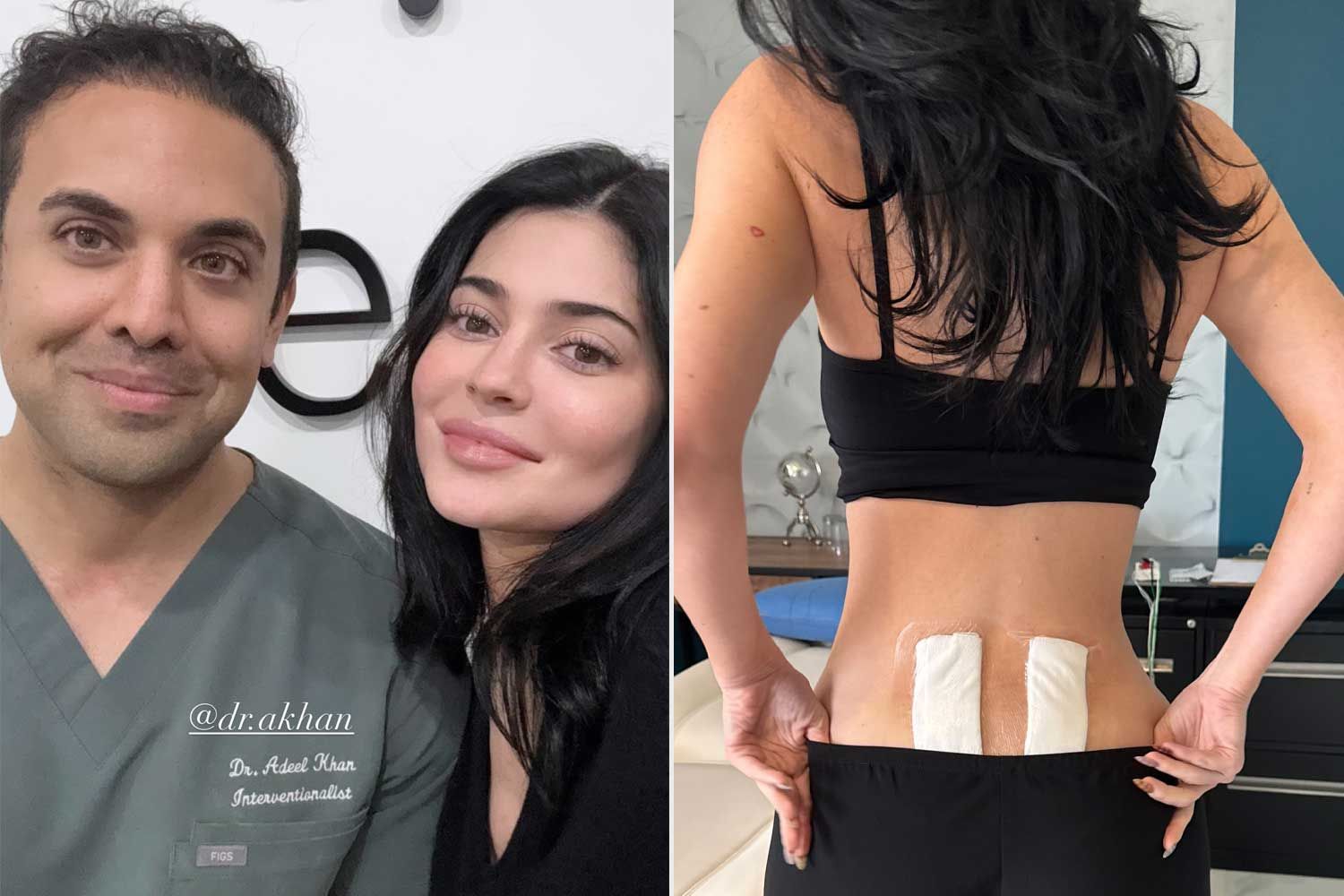 Kylie Jenner posing with Dr. Adeel Khan in a medical office, alongside a close-up of her lower back bandaged after stem cell therapy, showing her slimmer curves.